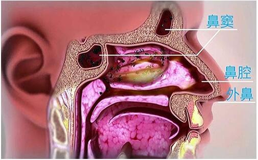 上颌窦炎的病因