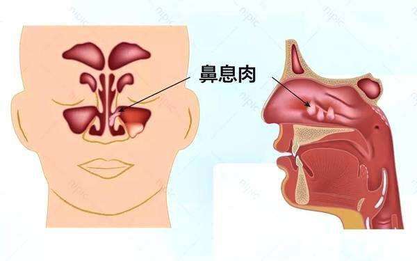 鼻息肉是怎么形成