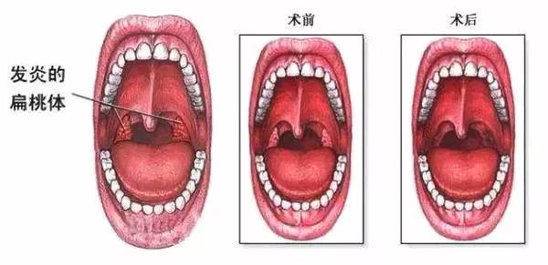 扁桃体炎