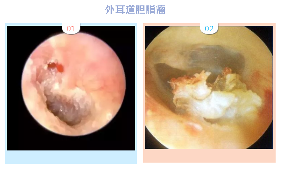 外耳道胆脂瘤