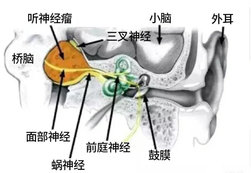 听神经瘤