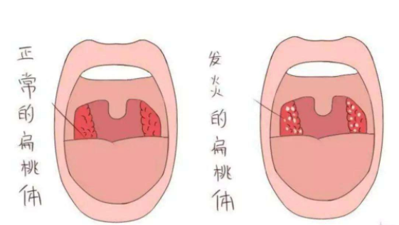 儿童扁桃体炎的护理方法