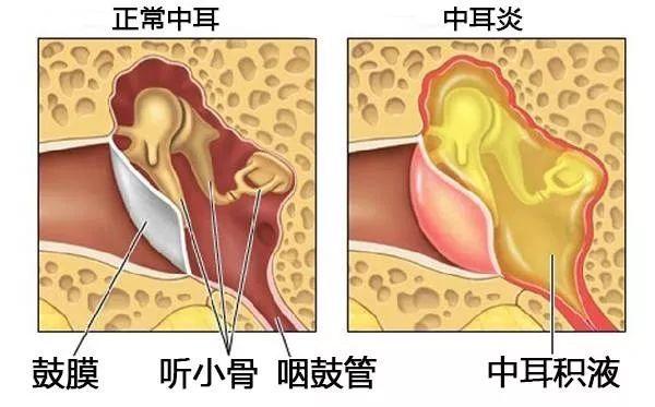 重庆儿童患上中耳炎的病因有哪些