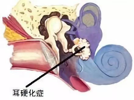 耳硬化症的术后注意事项