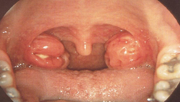 慢性咽炎的咽后壁，颗粒状巴滤泡增生↑