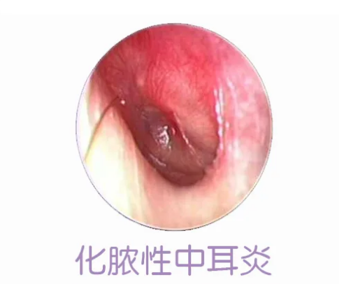 重庆中耳炎医院