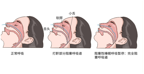 睡眠呼吸暂停综合征