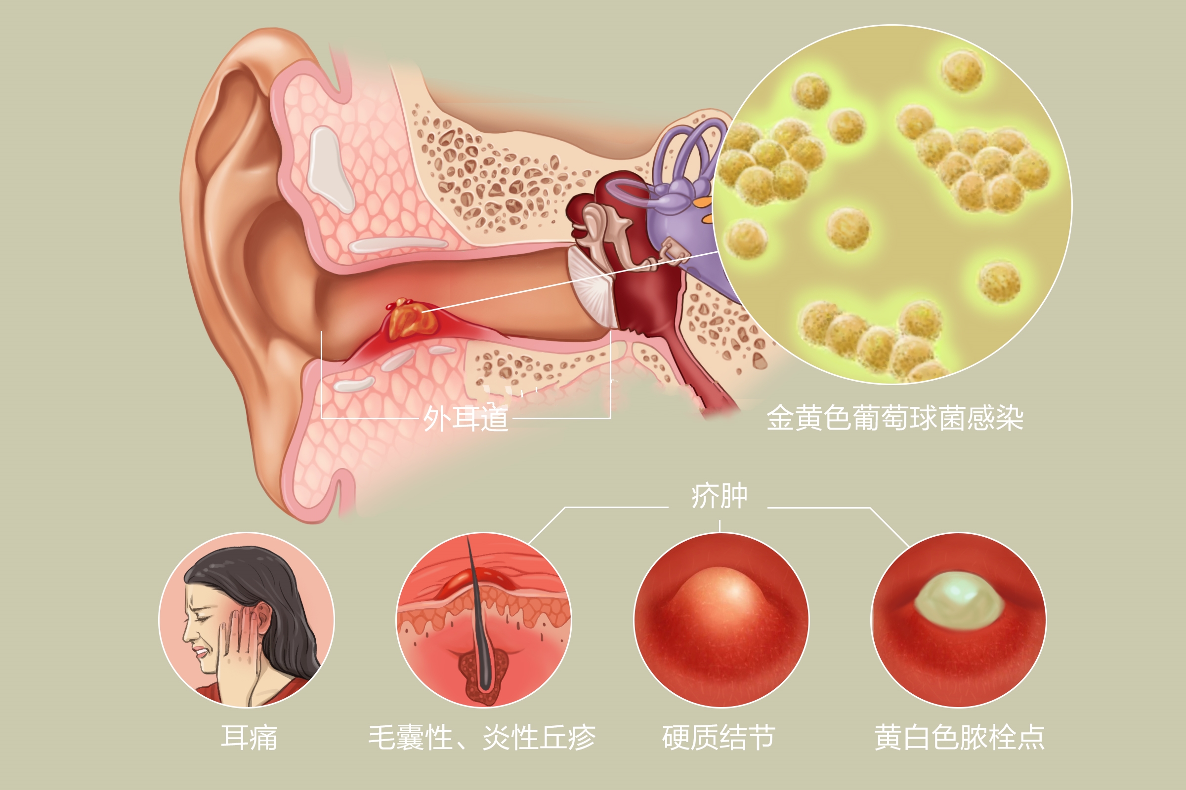 外耳道疖肿