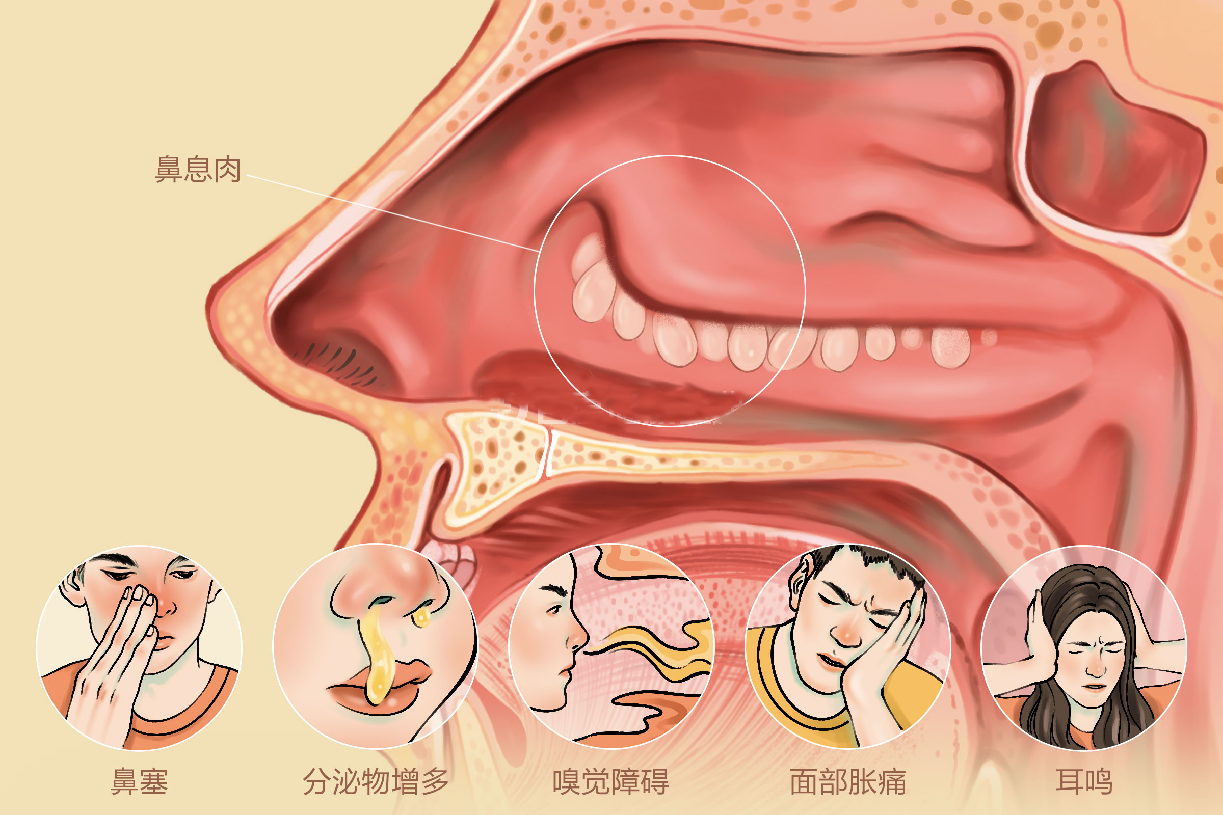 重庆治疗鼻息肉症状