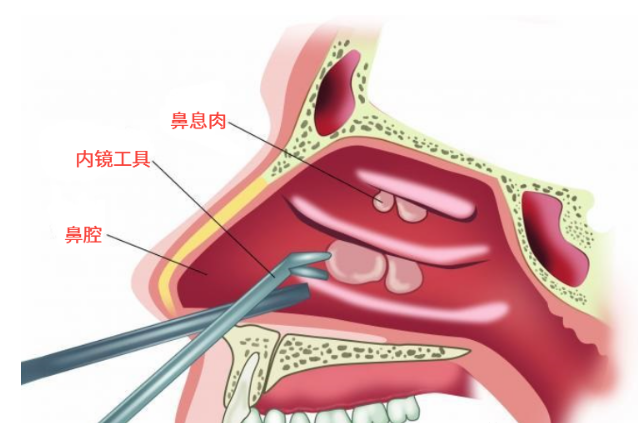 重庆看鼻息肉医院