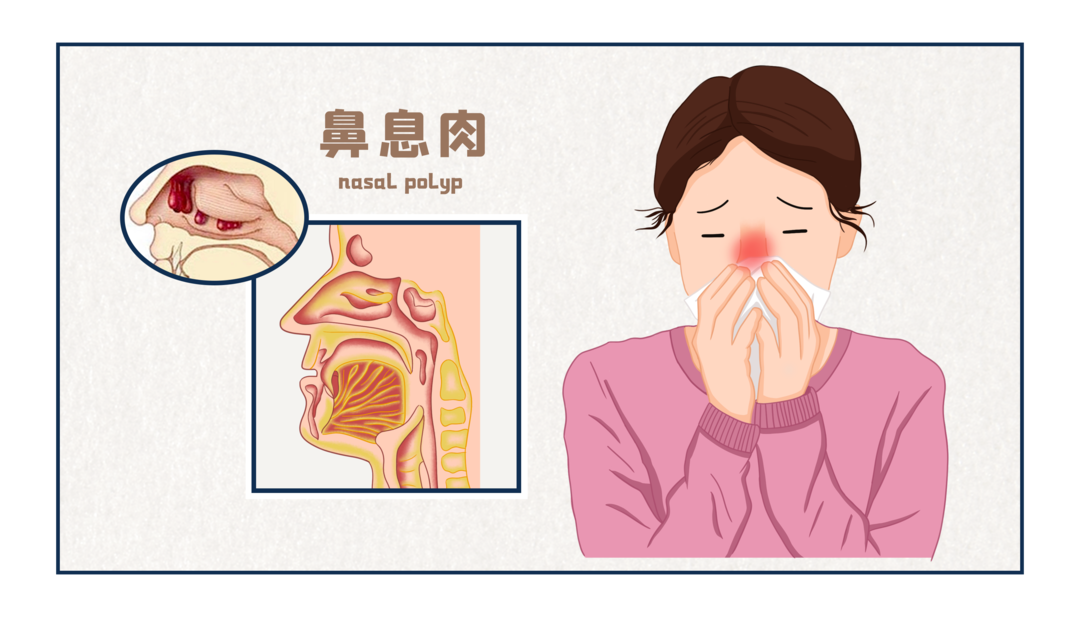 重庆鼻息肉医院