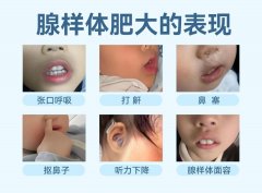 孩子腺样体肥大到底要不要管？耳鼻喉科医生