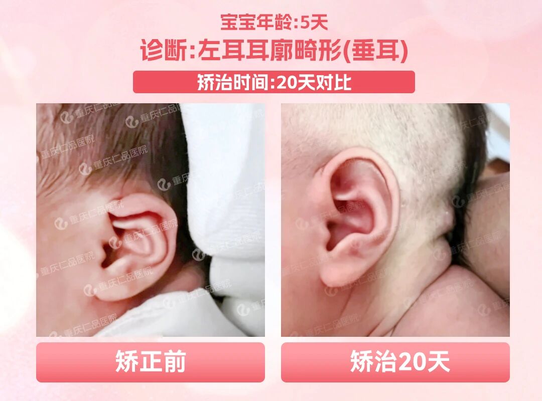 小耳畸形不止手术，仁品医院多维度干预方案